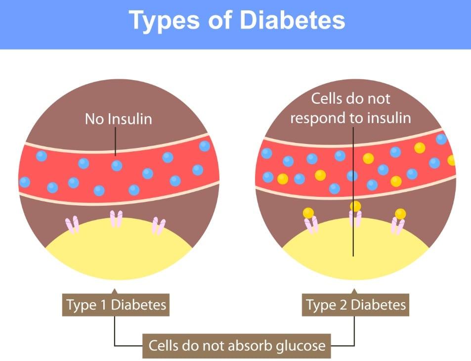 Diabetes_1