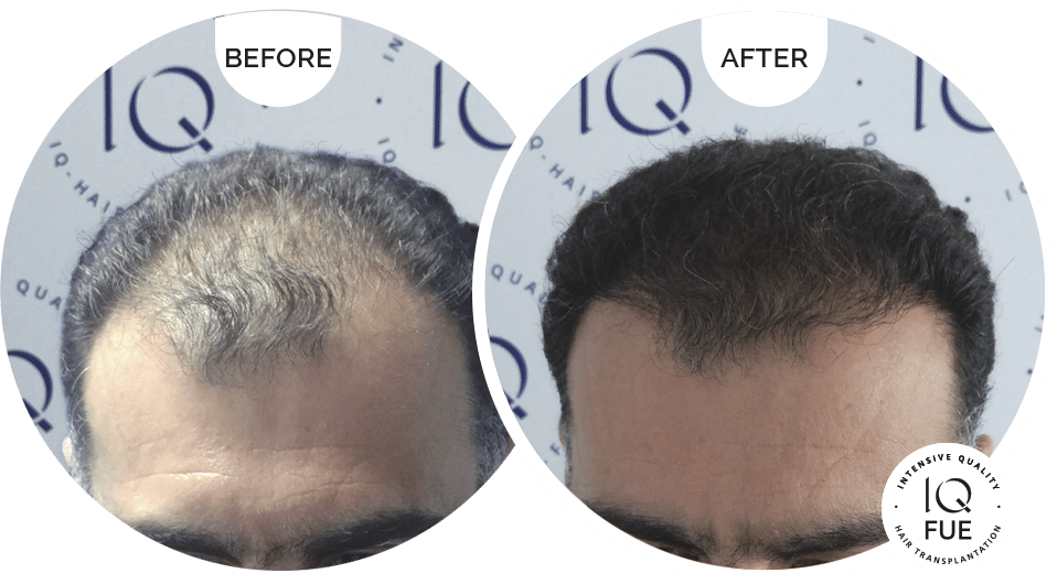 μεταμόσχευση μαλλιών IQ-FUE